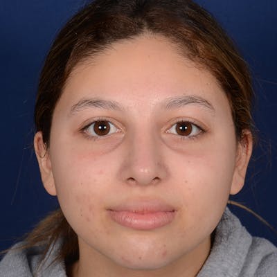 Female Rhinoplasty Before & After Gallery - Patient 518815 - Image 2