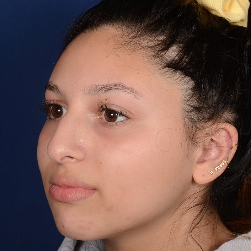 Female Rhinoplasty Before & After Gallery - Patient 518815 - Image 3