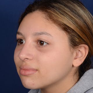 Female Rhinoplasty Before & After Gallery - Patient 518815 - Image 4