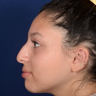 Female Rhinoplasty Before & After Gallery - Patient 518815 - Image 6