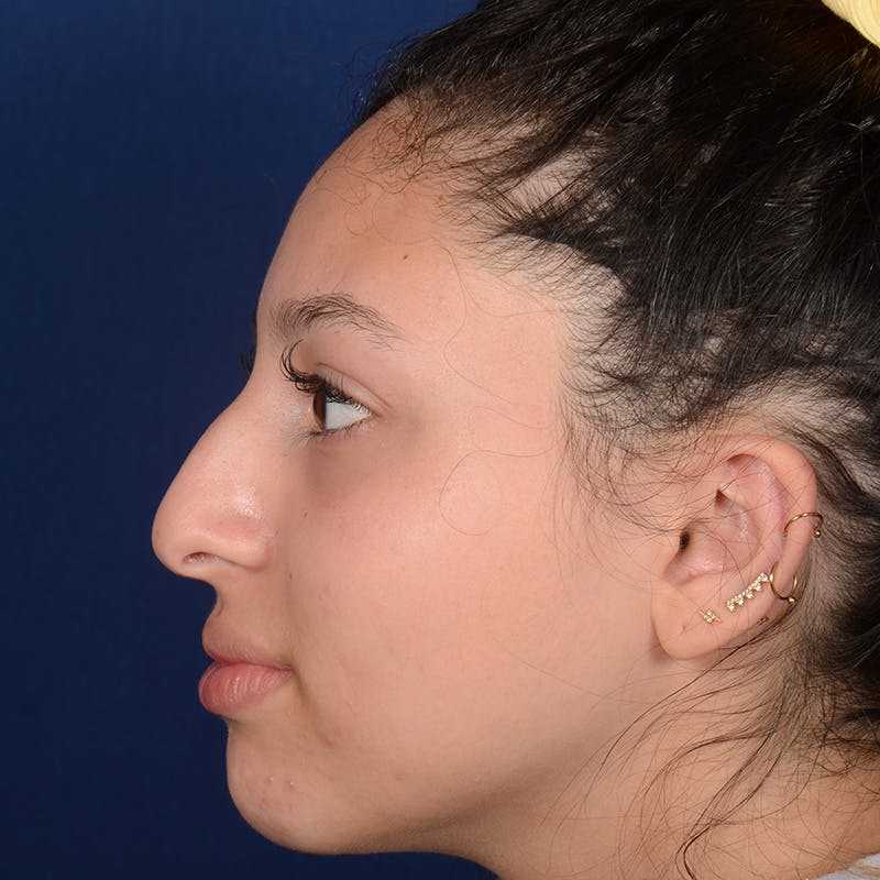 Female Rhinoplasty Before & After Gallery - Patient 518815 - Image 6