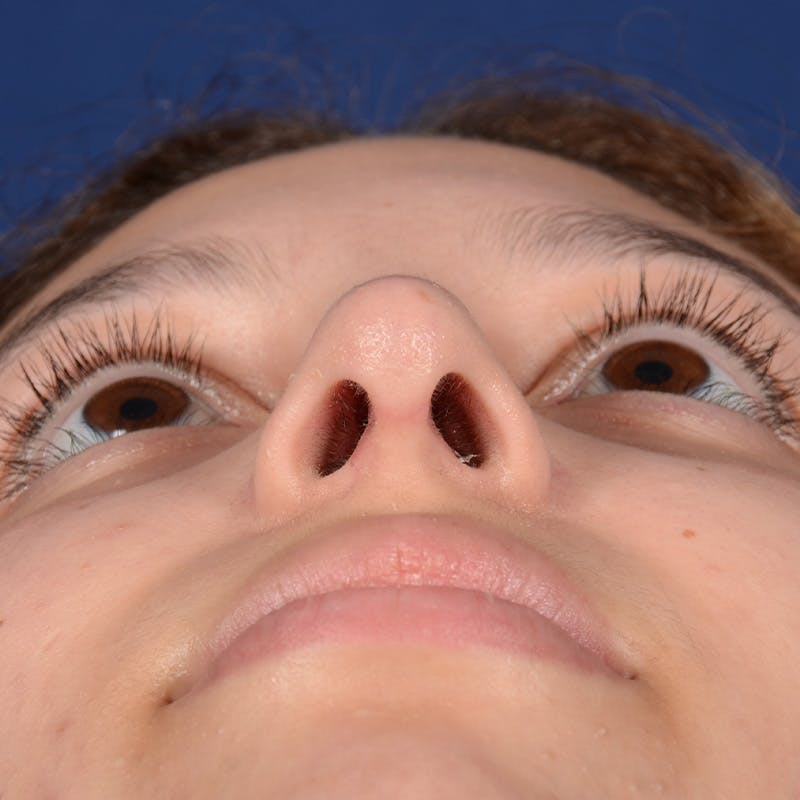 Female Rhinoplasty Before & After Gallery - Patient 518815 - Image 8