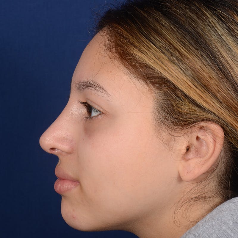 Female Rhinoplasty Before & After Gallery - Patient 518815 - Image 5