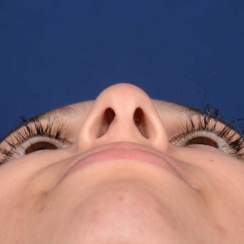 Female Rhinoplasty Before & After Gallery - Patient 518815 - Image 7