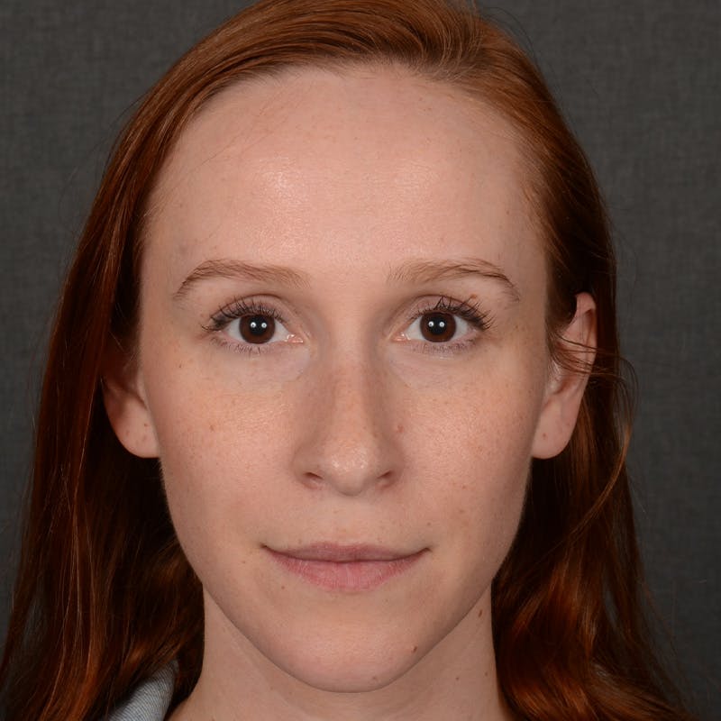 Female Rhinoplasty Before & After Gallery - Patient 232430 - Image 1
