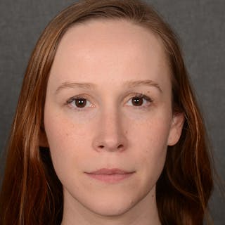 Female Rhinoplasty Before & After Gallery - Patient 232430 - Image 2