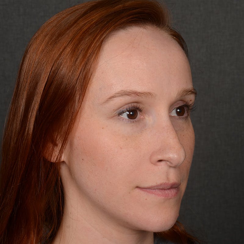Female Rhinoplasty Before & After Gallery - Patient 232430 - Image 3