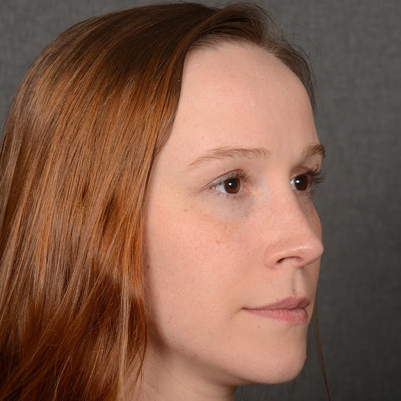 Female Rhinoplasty Before & After Gallery - Patient 232430 - Image 4