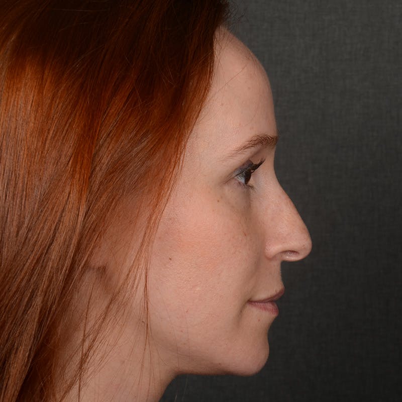 Female Rhinoplasty Before & After Gallery - Patient 232430 - Image 5