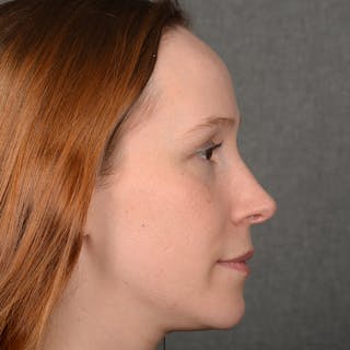 Female Rhinoplasty Before & After Gallery - Patient 232430 - Image 6