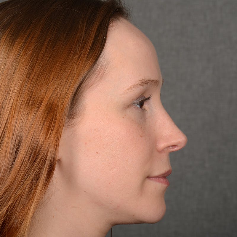 Female Rhinoplasty Before & After Gallery - Patient 232430 - Image 6