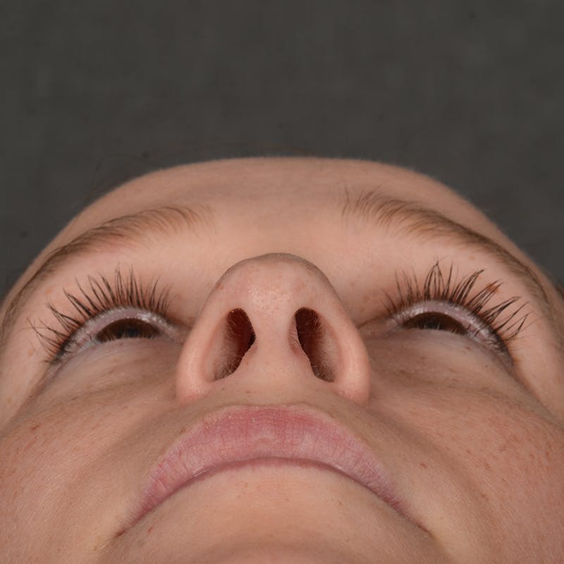 Female Rhinoplasty Before & After Gallery - Patient 232430 - Image 7