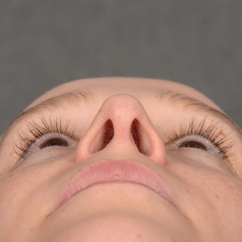 Female Rhinoplasty Before & After Gallery - Patient 232430 - Image 8