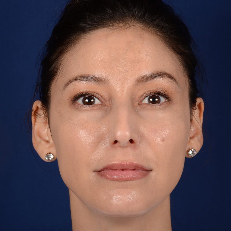 Female Rhinoplasty Before & After Gallery - Patient 406675 - Image 1