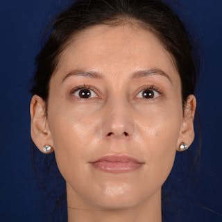 Female Rhinoplasty Before & After Gallery - Patient 406675 - Image 2