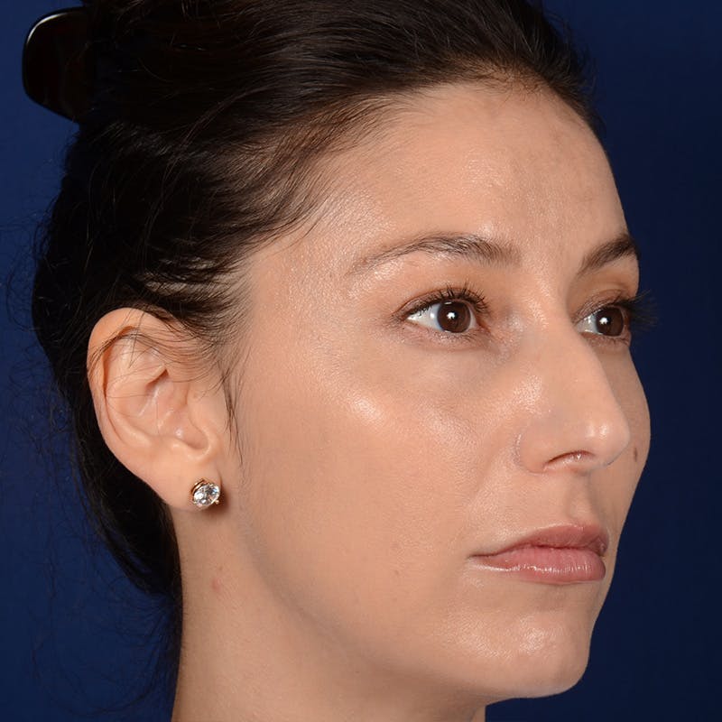 Female Rhinoplasty Before & After Gallery - Patient 406675 - Image 3