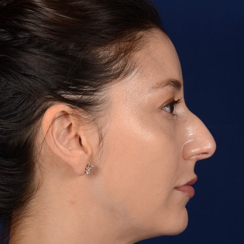 Female Rhinoplasty Before & After Gallery - Patient 406675 - Image 5