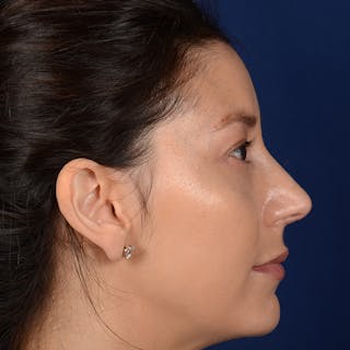 Female Rhinoplasty Before & After Gallery - Patient 406675 - Image 6