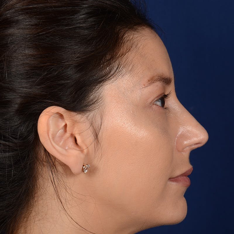 Female Rhinoplasty Before & After Gallery - Patient 406675 - Image 6
