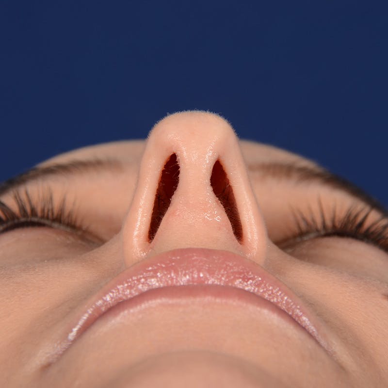 Female Rhinoplasty Before & After Gallery - Patient 406675 - Image 7