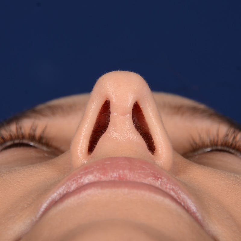 Female Rhinoplasty Before & After Gallery - Patient 406675 - Image 8