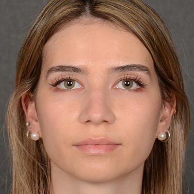 Female Rhinoplasty Before & After Gallery - Patient 219049 - Image 1