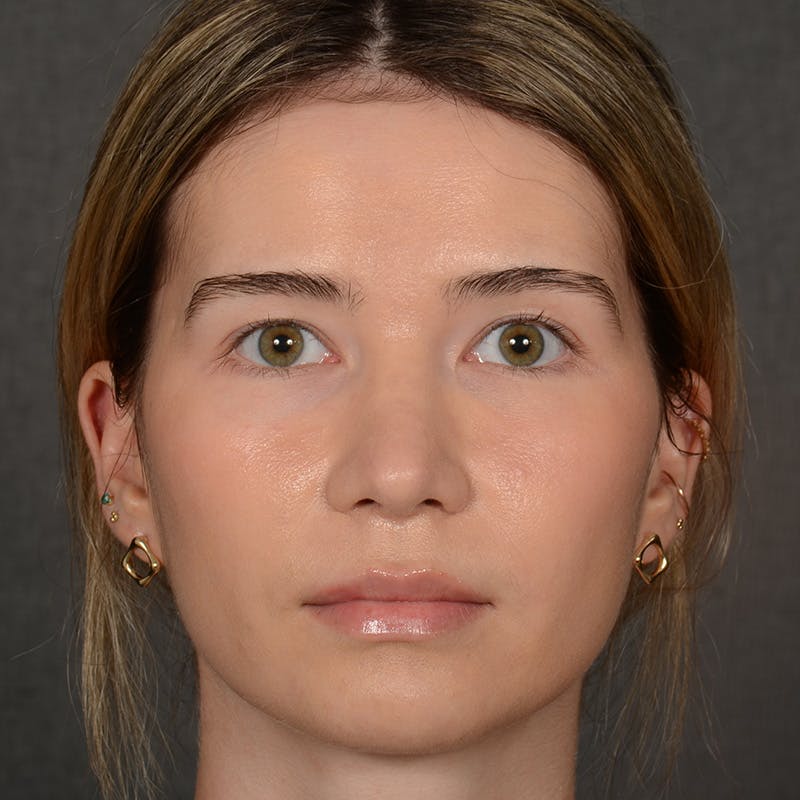 Female Rhinoplasty Before & After Gallery - Patient 219049 - Image 2