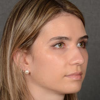 Female Rhinoplasty Before & After Gallery - Patient 219049 - Image 4