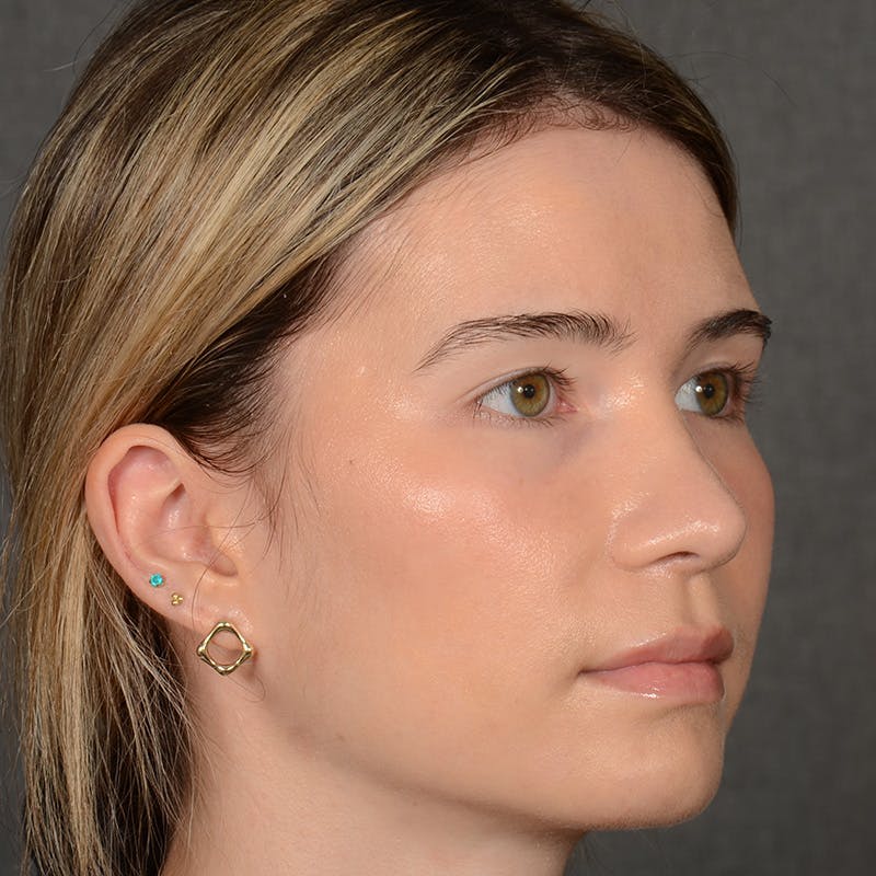 Female Rhinoplasty Before & After Gallery - Patient 219049 - Image 3