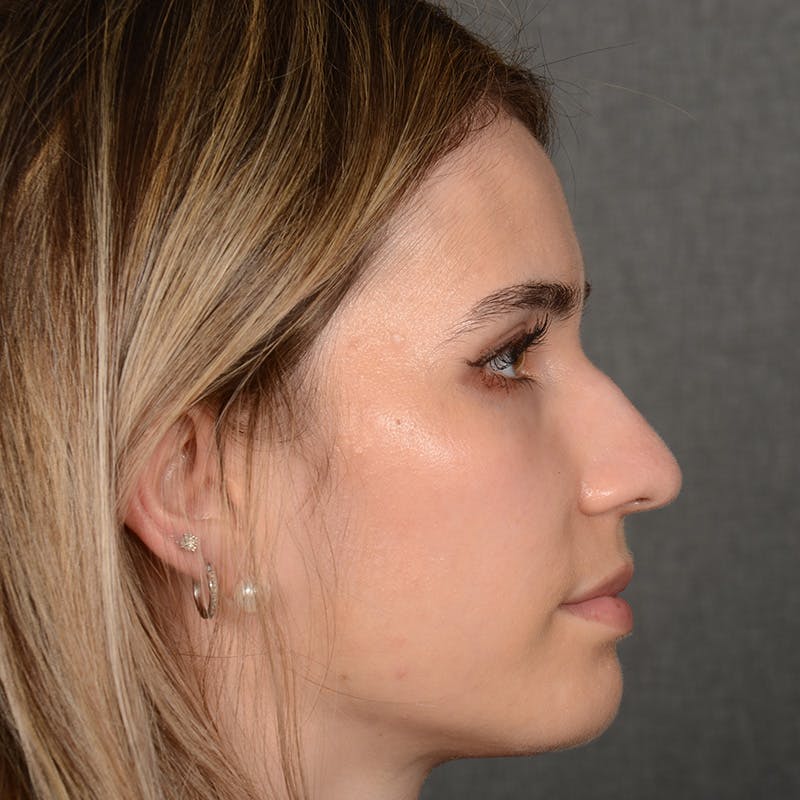 Female Rhinoplasty Before & After Gallery - Patient 219049 - Image 7