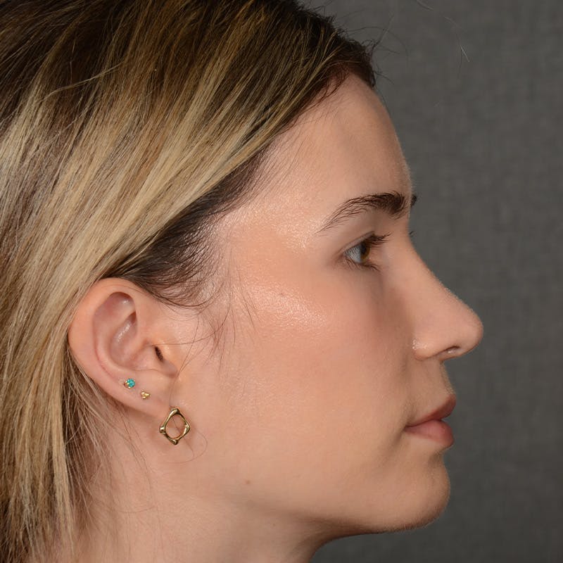 Female Rhinoplasty Before & After Gallery - Patient 219049 - Image 6