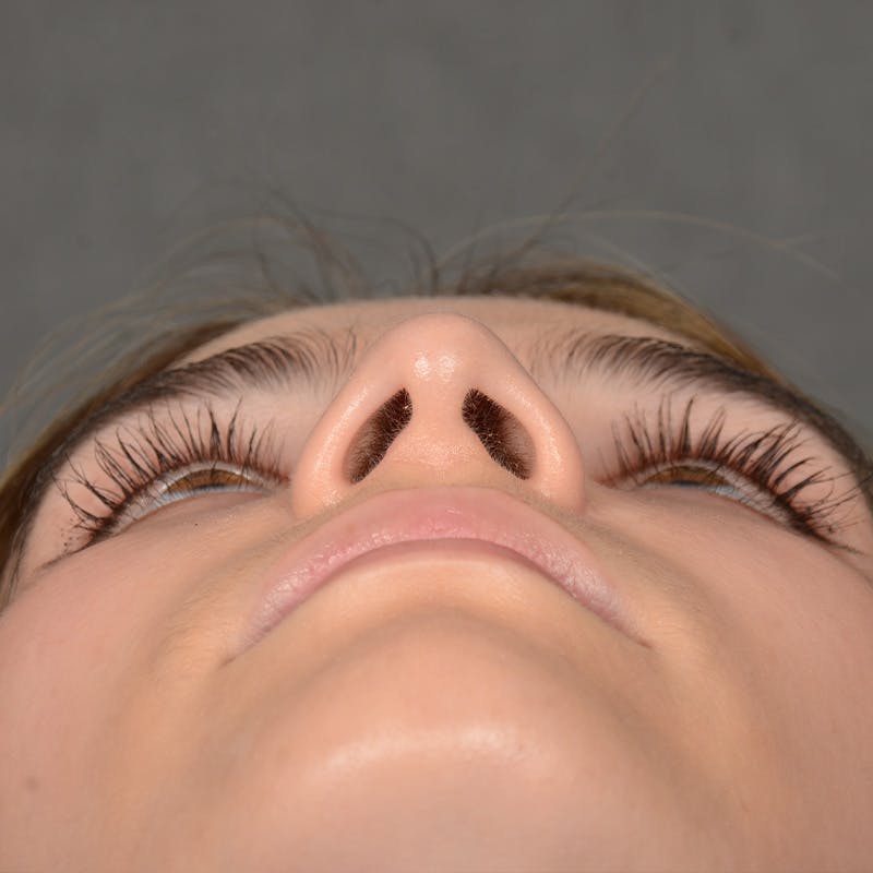 Female Rhinoplasty Before & After Gallery - Patient 219049 - Image 8