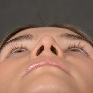 Female Rhinoplasty Before & After Gallery - Patient 219049 - Image 8