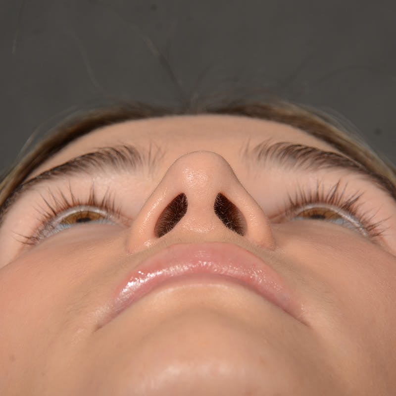 Female Rhinoplasty Before & After Gallery - Patient 219049 - Image 5