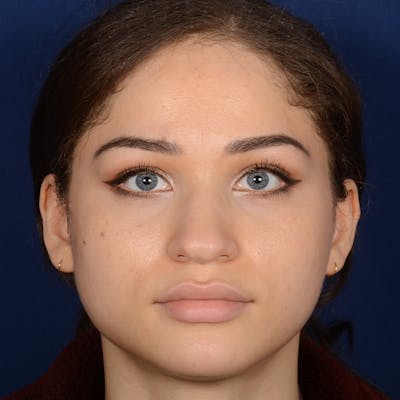 Female Rhinoplasty Before & After Gallery - Patient 152047 - Image 1