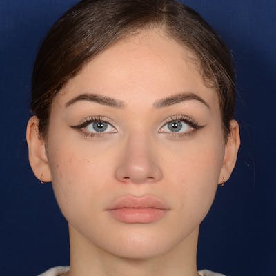 Female Rhinoplasty Before & After Gallery - Patient 152047 - Image 2
