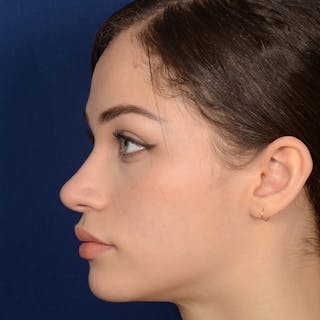 Female Rhinoplasty Before & After Gallery - Patient 152047 - Image 6