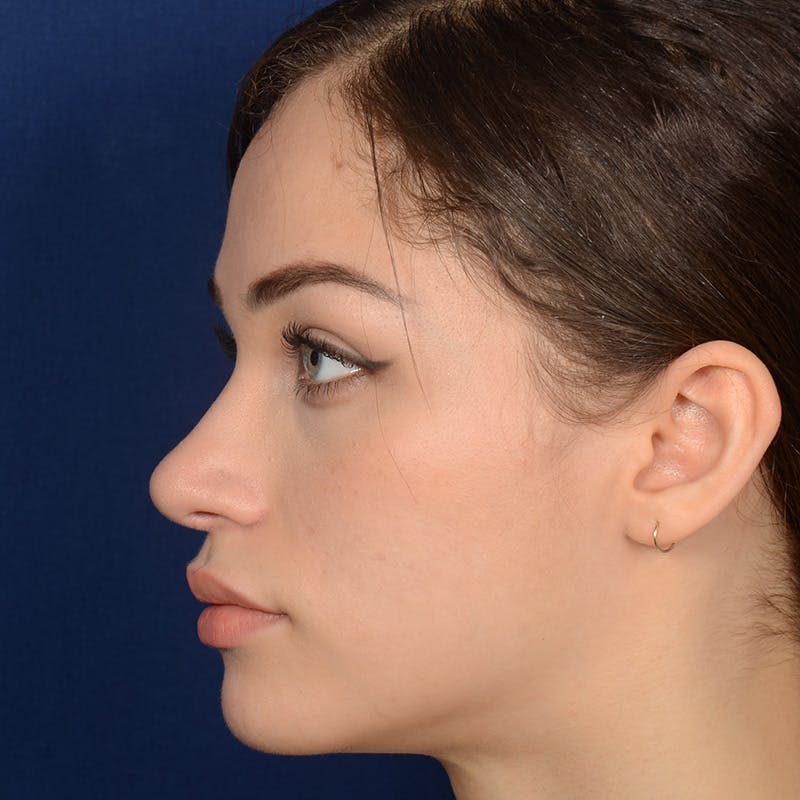 Female Rhinoplasty Before & After Gallery - Patient 152047 - Image 6