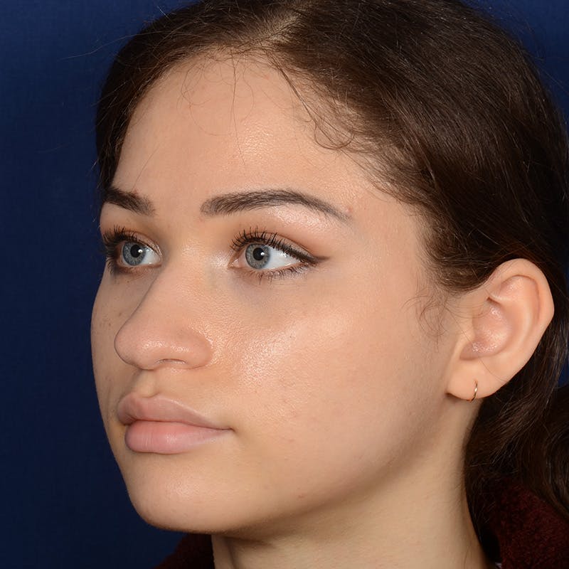 Female Rhinoplasty Before & After Gallery - Patient 152047 - Image 3