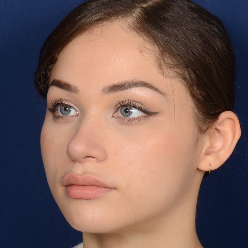 Female Rhinoplasty Before & After Gallery - Patient 152047 - Image 4