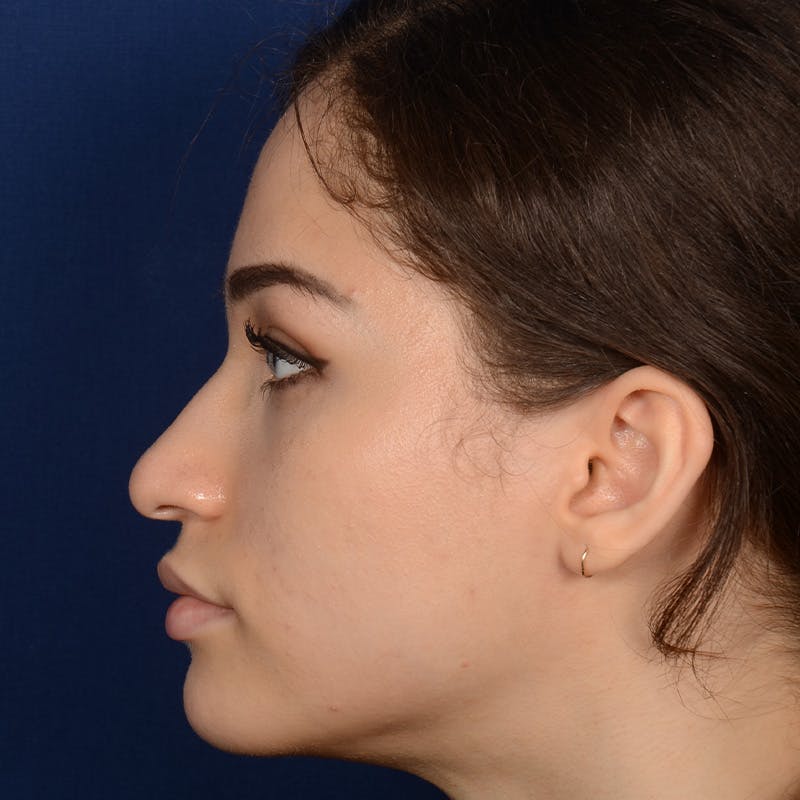 Female Rhinoplasty Before & After Gallery - Patient 152047 - Image 5