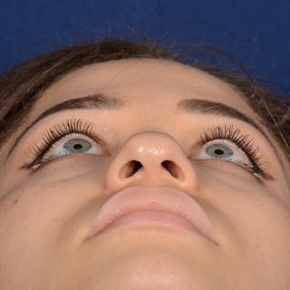 Female Rhinoplasty Before & After Gallery - Patient 152047 - Image 8