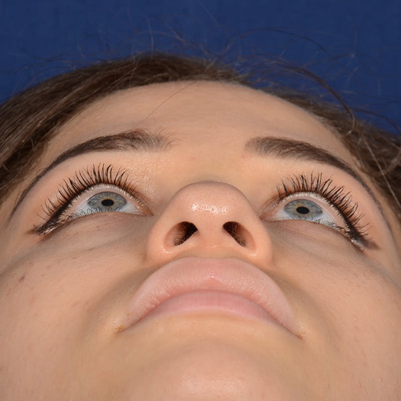 Female Rhinoplasty Before & After Gallery - Patient 152047 - Image 8