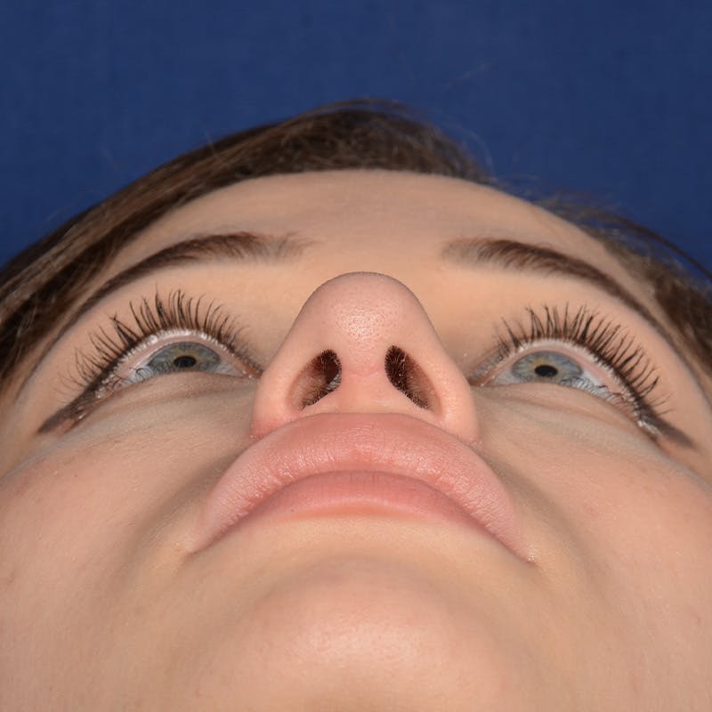 Female Rhinoplasty Before & After Gallery - Patient 152047 - Image 7