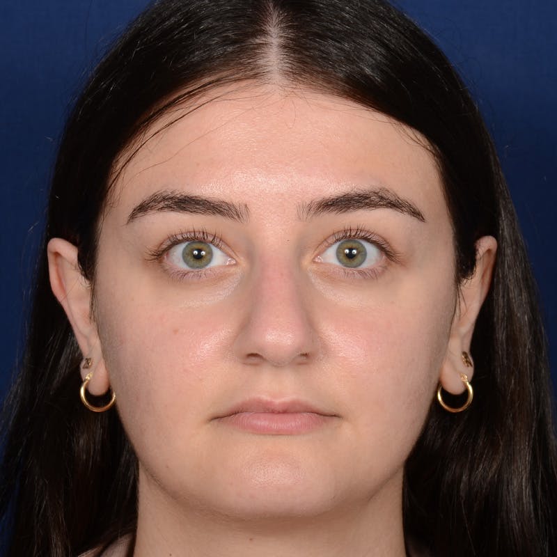 Female Rhinoplasty Before & After Gallery - Patient 394381 - Image 1