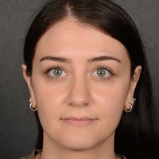 Female Rhinoplasty Before & After Gallery - Patient 394381 - Image 2