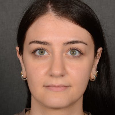 Female Rhinoplasty Before & After Gallery - Patient 394381 - Image 2