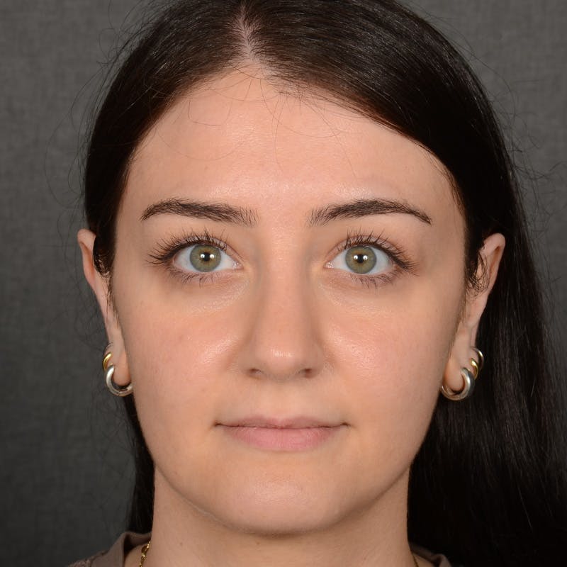 Female Rhinoplasty Before & After Gallery - Patient 394381 - Image 2