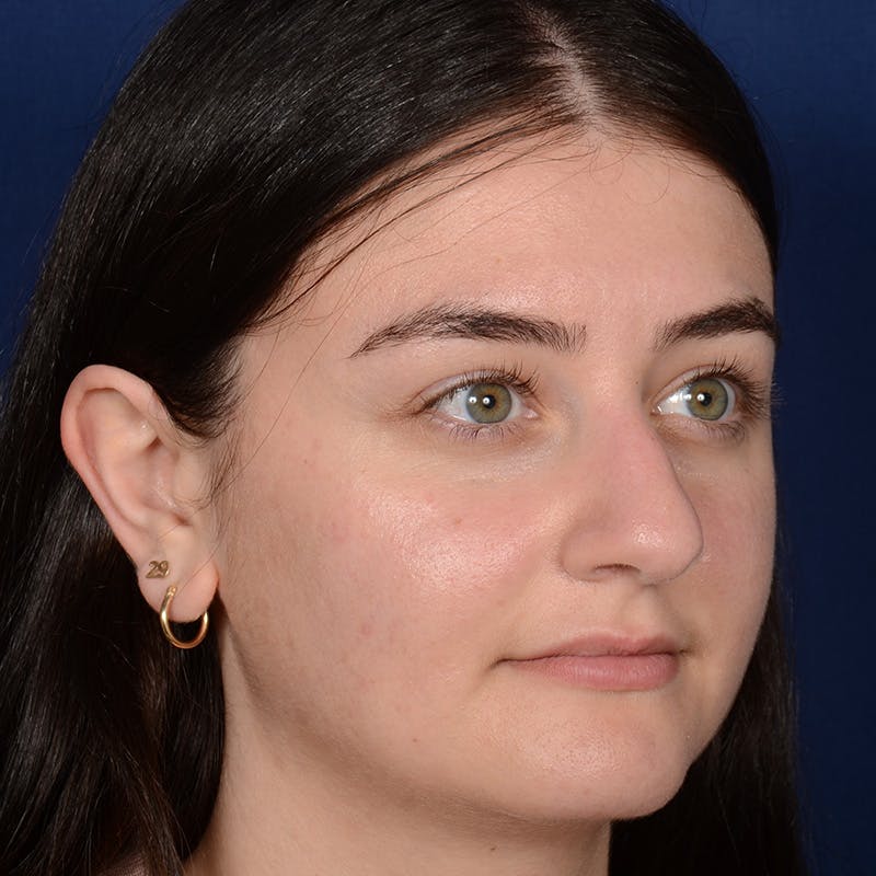 Female Rhinoplasty Before & After Gallery - Patient 394381 - Image 3