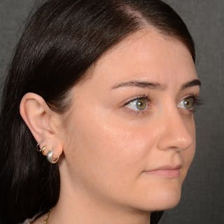 Female Rhinoplasty Before & After Gallery - Patient 394381 - Image 4